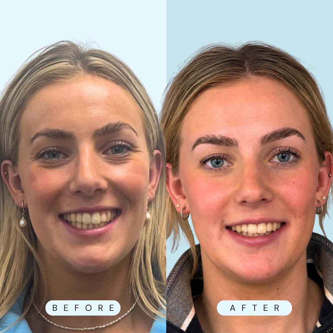before and after dental treatment patient comparison