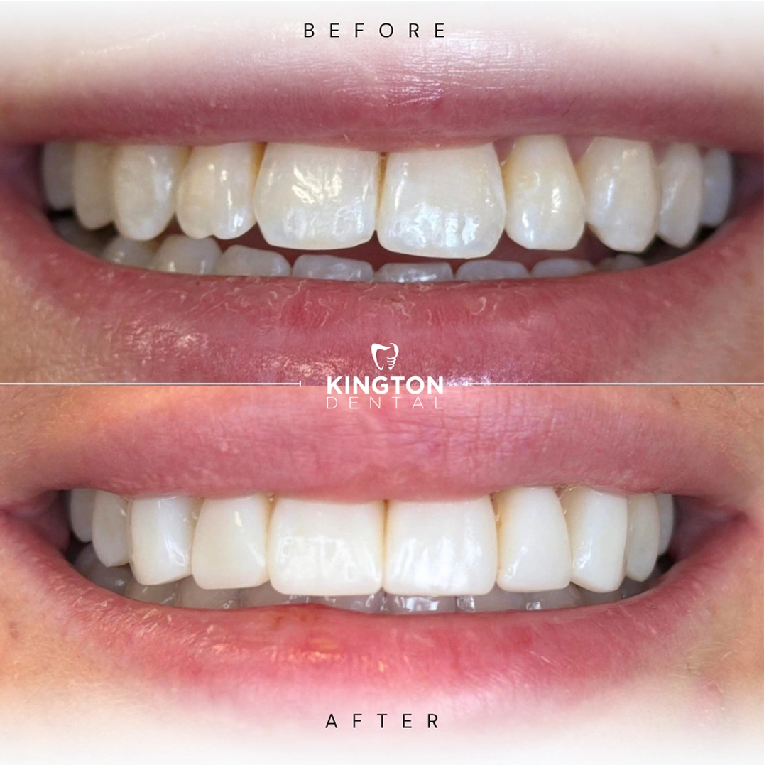 before and after dental treatment patient comparison